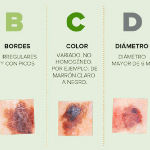 Cáncer de piel 