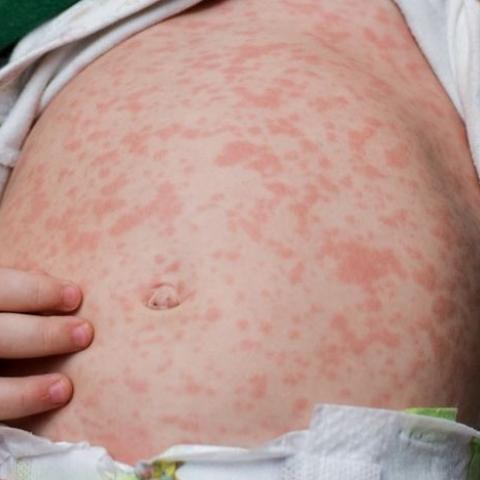 Pueden pasar 10 días para presentar primeros síntomas de sarampión y contagias mientras tanto 