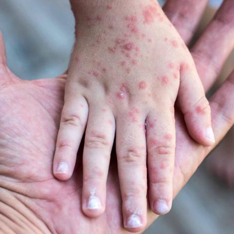 Confirma ISSEA segundo caso de sarampión en 2026; es la madre de niña contagiada 