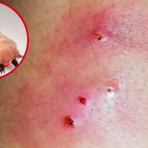 gusano barrenador en humanos