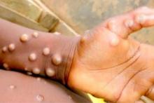 mpox