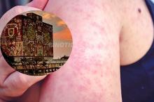 UNAM llama a prevenir la propagación del sarampión, ante rebrote en Europa