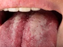 Alerta especialista sobre el riesgo de hongo ‘candida albicans’ en pacientes con demencia