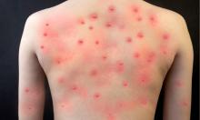 Mpox 
