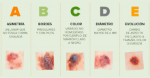 Cáncer de piel 